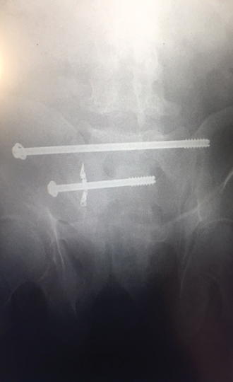 Screws in Kevin Newton's pelvis